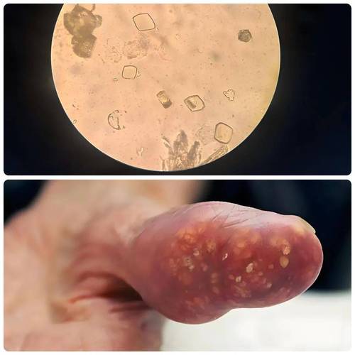 痛风怎么看有没有结晶