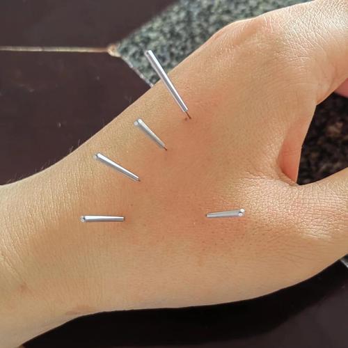 针灸治疗失眠的效果