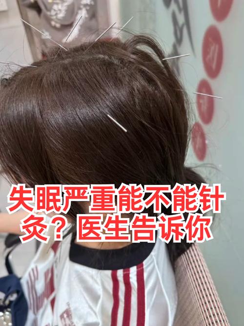 针灸治疗失眠的效果