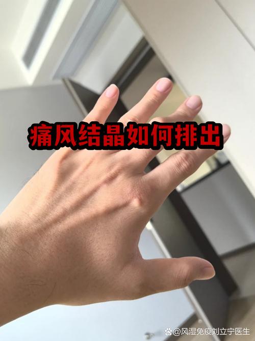 怎么去除痛风关节结晶