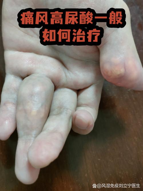 痛风多少为正常尿酸值