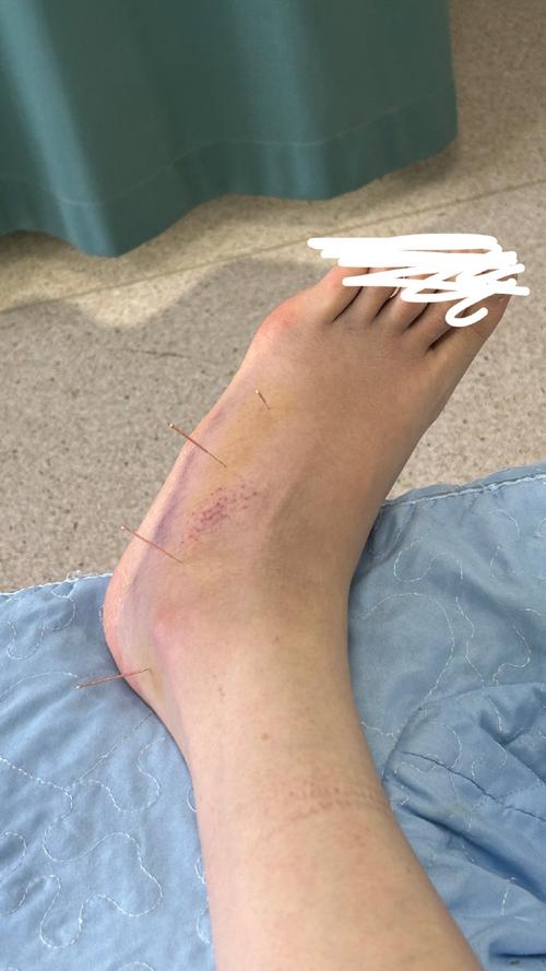 针灸后感觉脚跟很紧