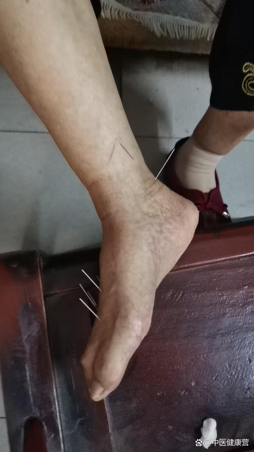 针灸后感觉脚跟很紧