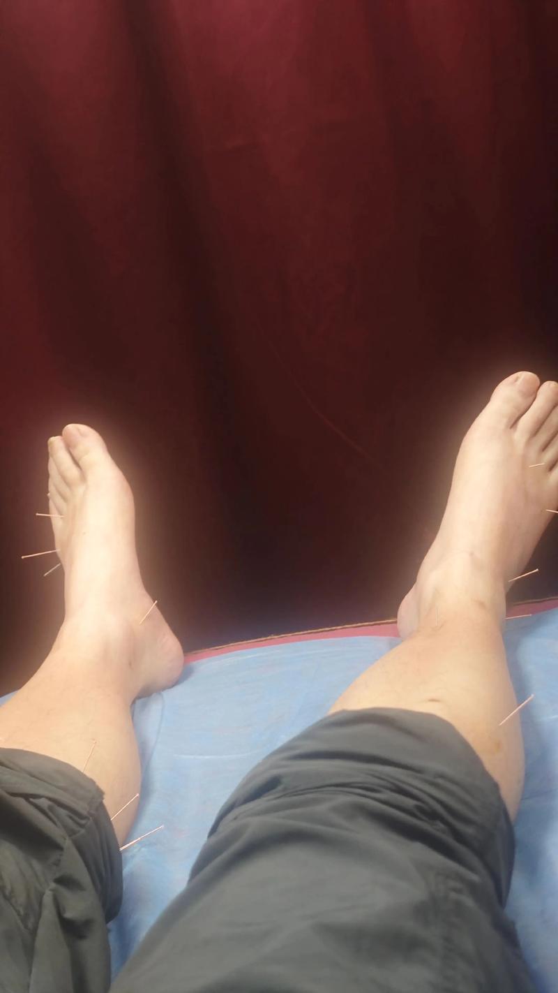 脚扭伤中医针灸治疗