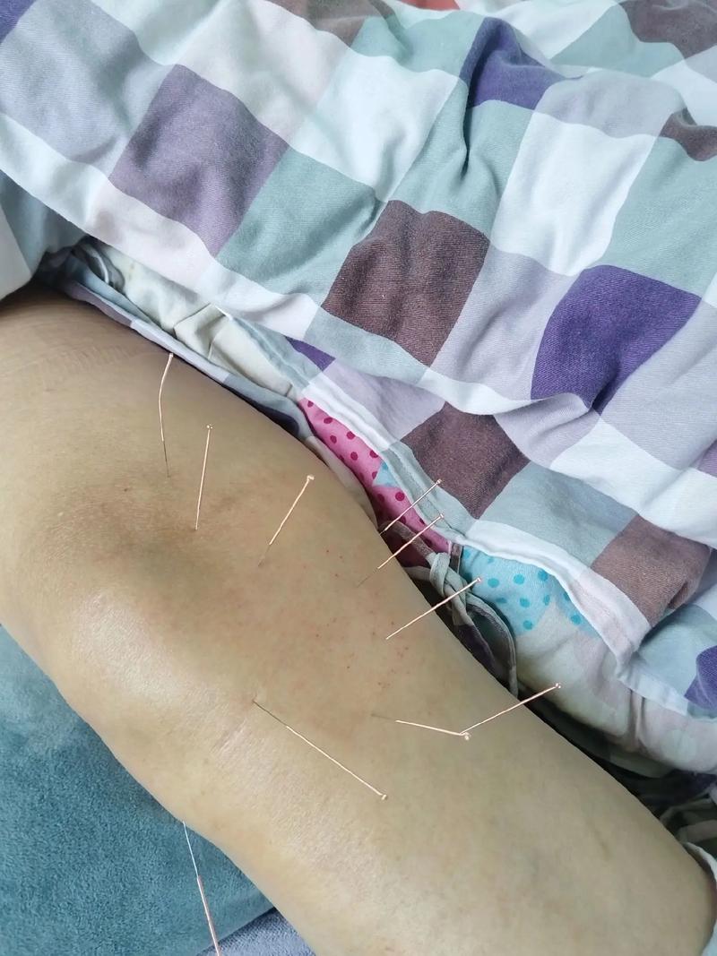 针灸可以治疗寒腿吗