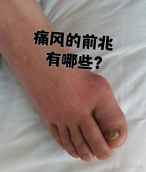 痛风前期症状是什么样