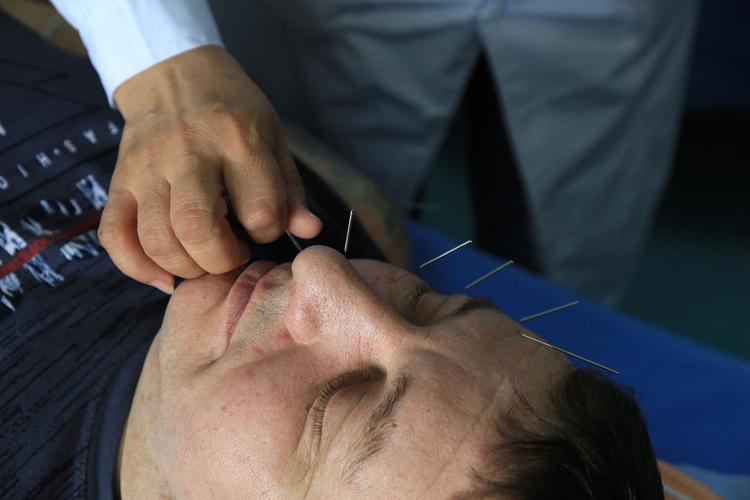 面瘫针灸针哪边最好