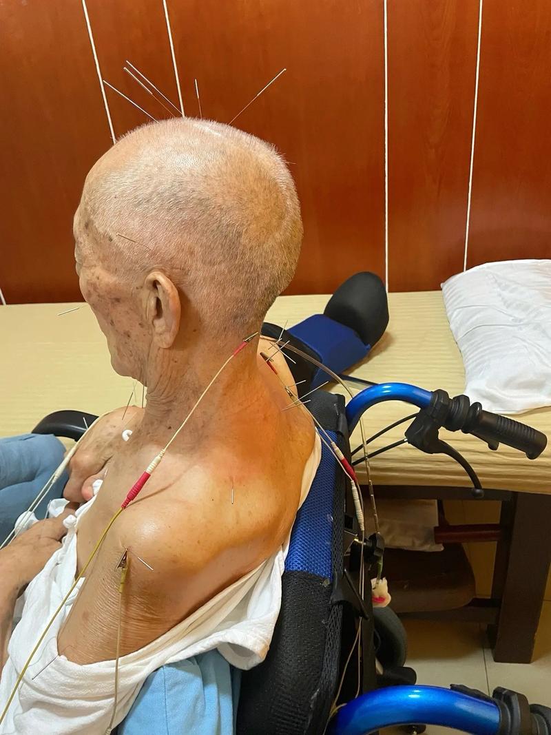 中医针灸治疗脑积水