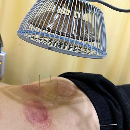 湿气重背部针灸放血