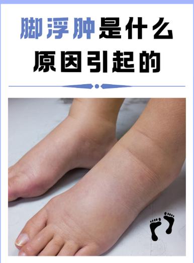 痛风引起的脚肿怎么办