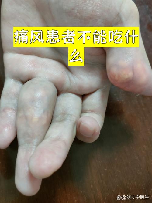 痛风为什么不能吃菜花