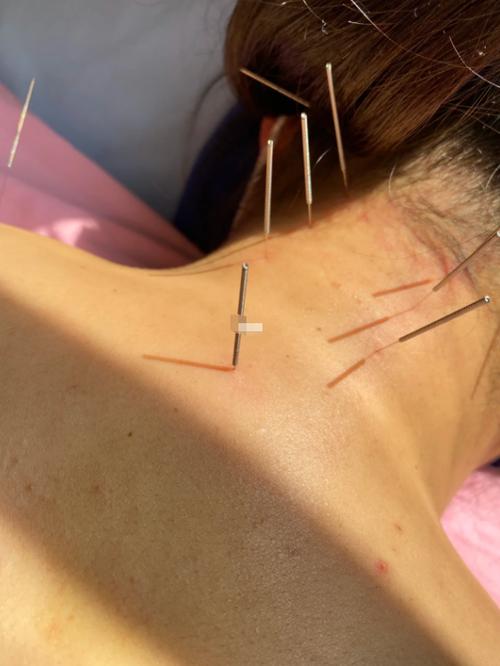 针灸可以治疗高血压