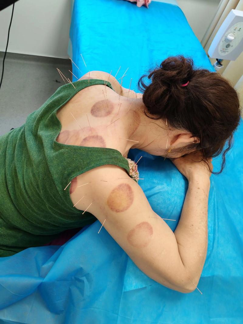 针灸丰胸根本没效果