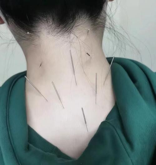 针灸穿什么衣服方便