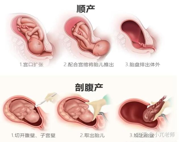 抛妇产和顺产哪个安全