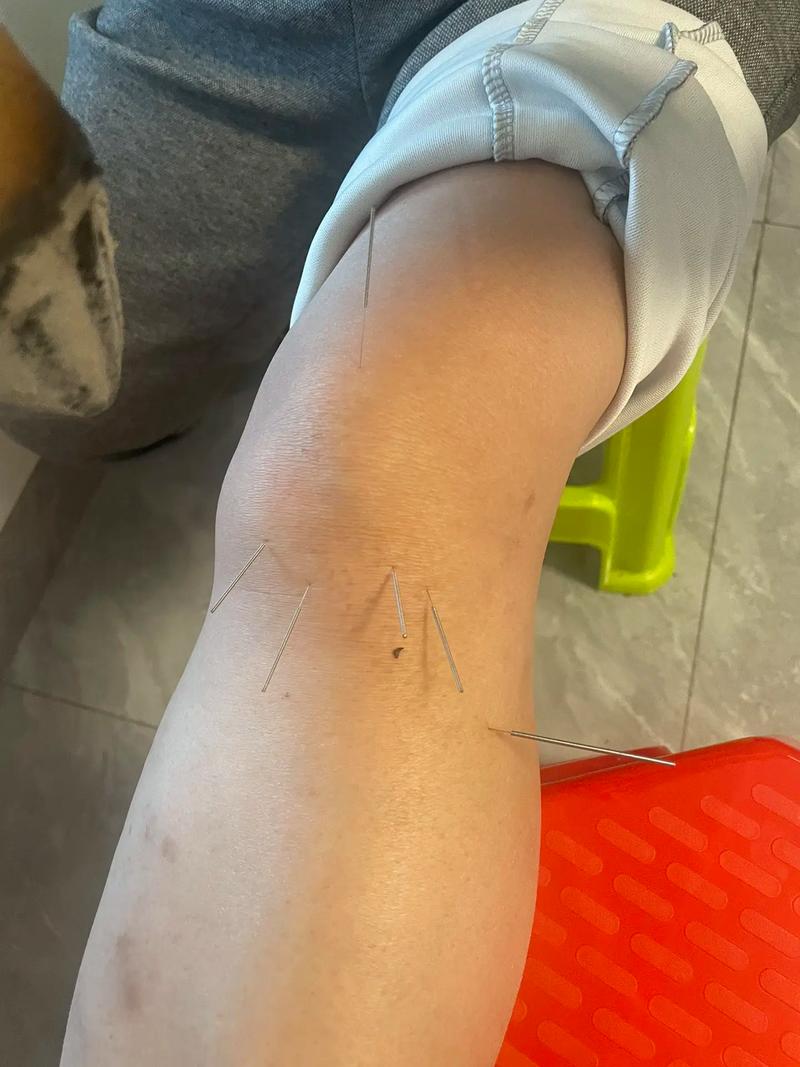 针灸治疗膝盖滑膜炎