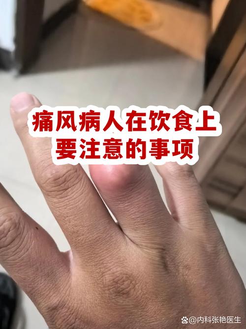 痛风能吃鸡蛋和牛奶吗