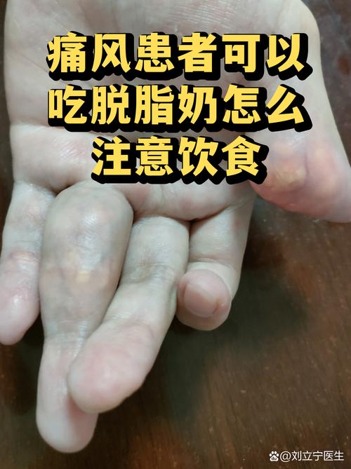 痛风能吃鸡蛋和牛奶吗
