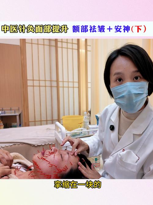 怀孕可以面部针灸吗