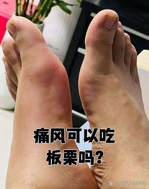痛风患者可以吃板栗吗