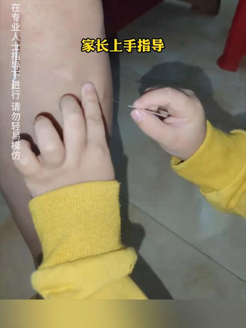 婴儿针灸有什么效果