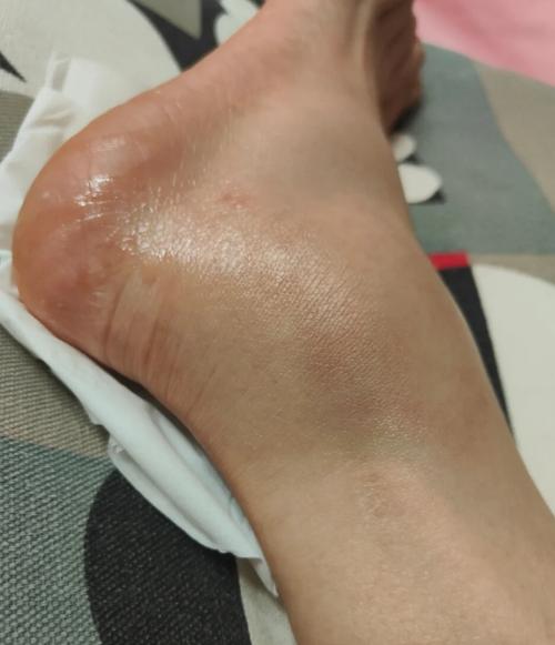 痛风脚脖子肿了怎么办