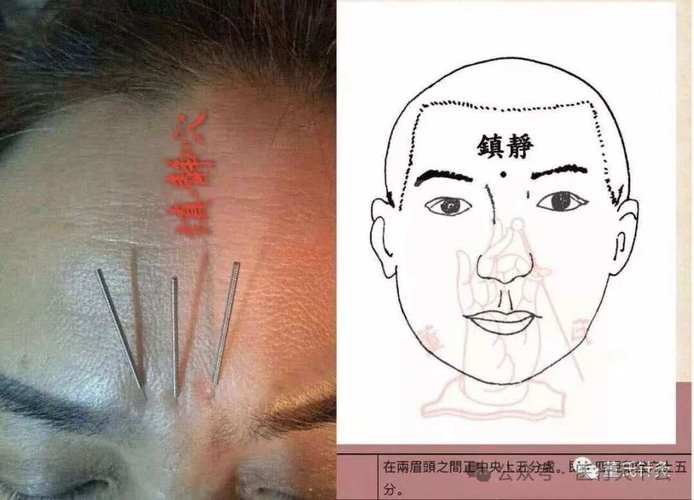 针灸印堂治疗什么病
