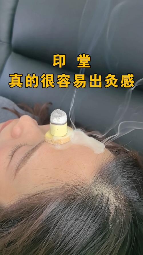 针灸印堂治疗什么病