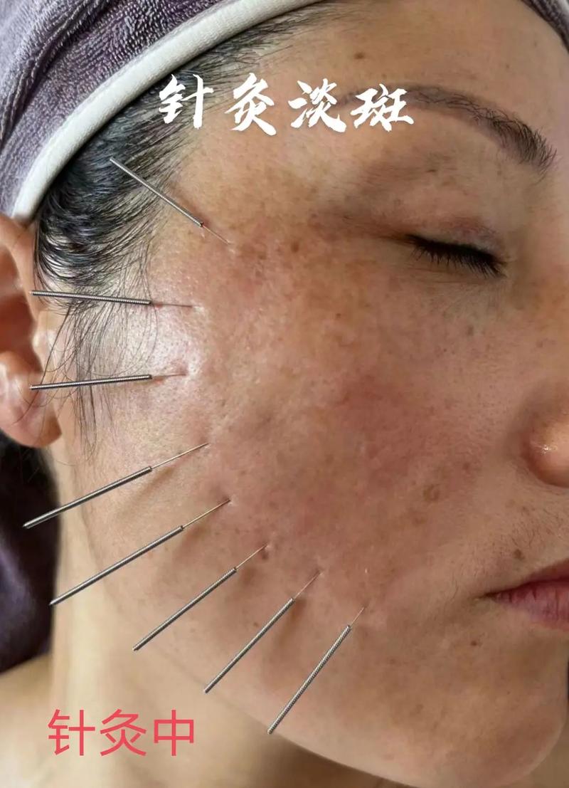 黄斑病变的针灸治疗