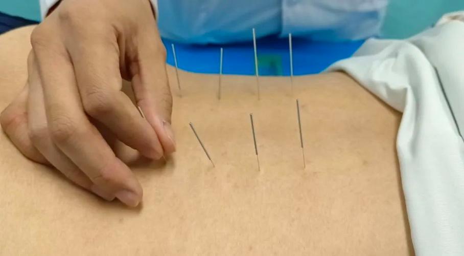 腰肌劳损扎针灸图示