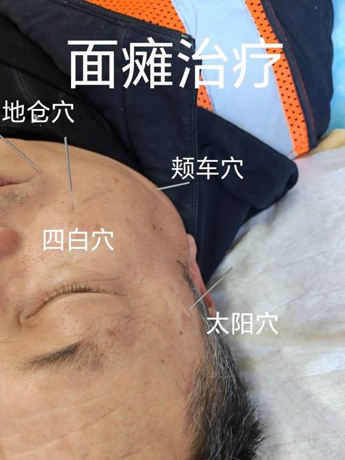 针灸治疗面瘫副作用