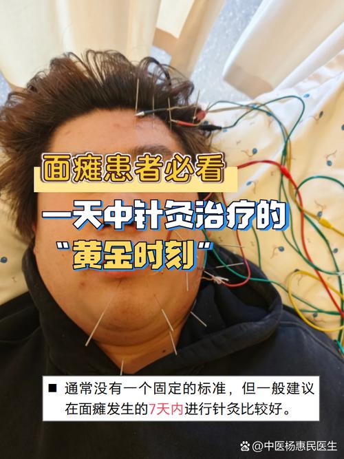 针灸治疗面瘫副作用