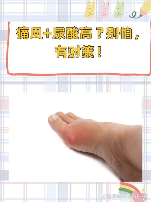 尿酸高但没有痛风症状