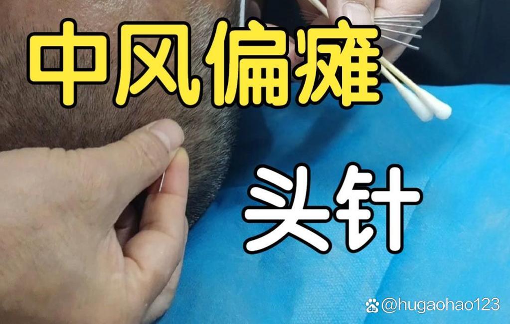 针灸扎头部治疗什么