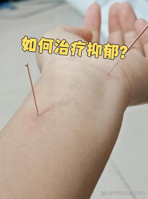 针灸治疗抑郁有效吗