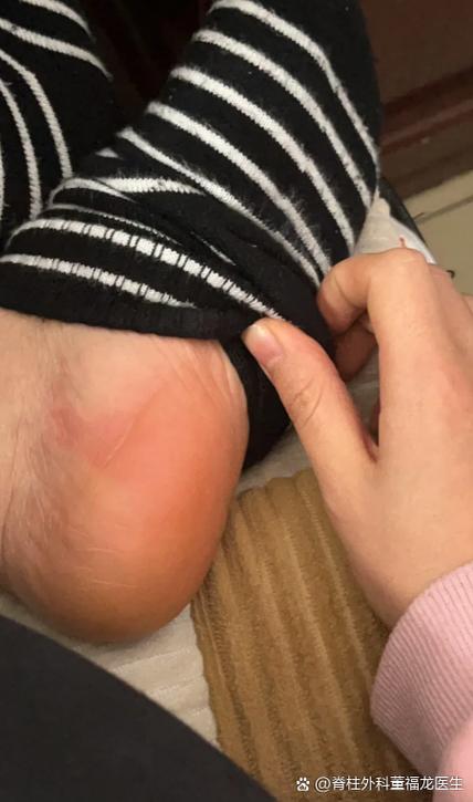 脚后跟疼是痛风的前兆