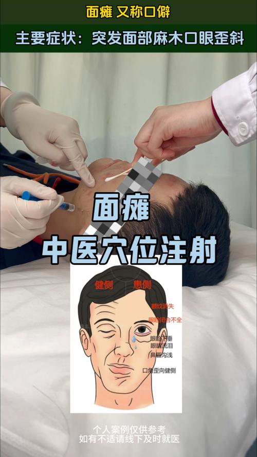 面瘫可以每天针灸吗