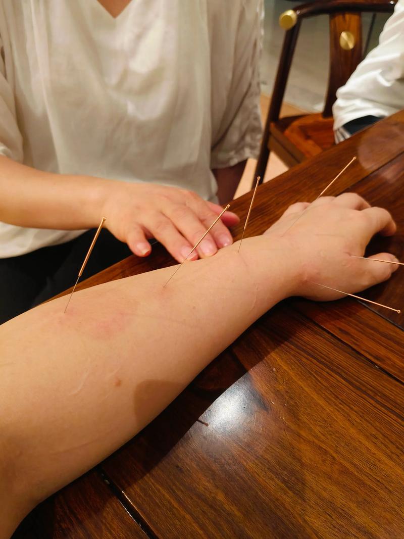 生气后针灸哪里合适