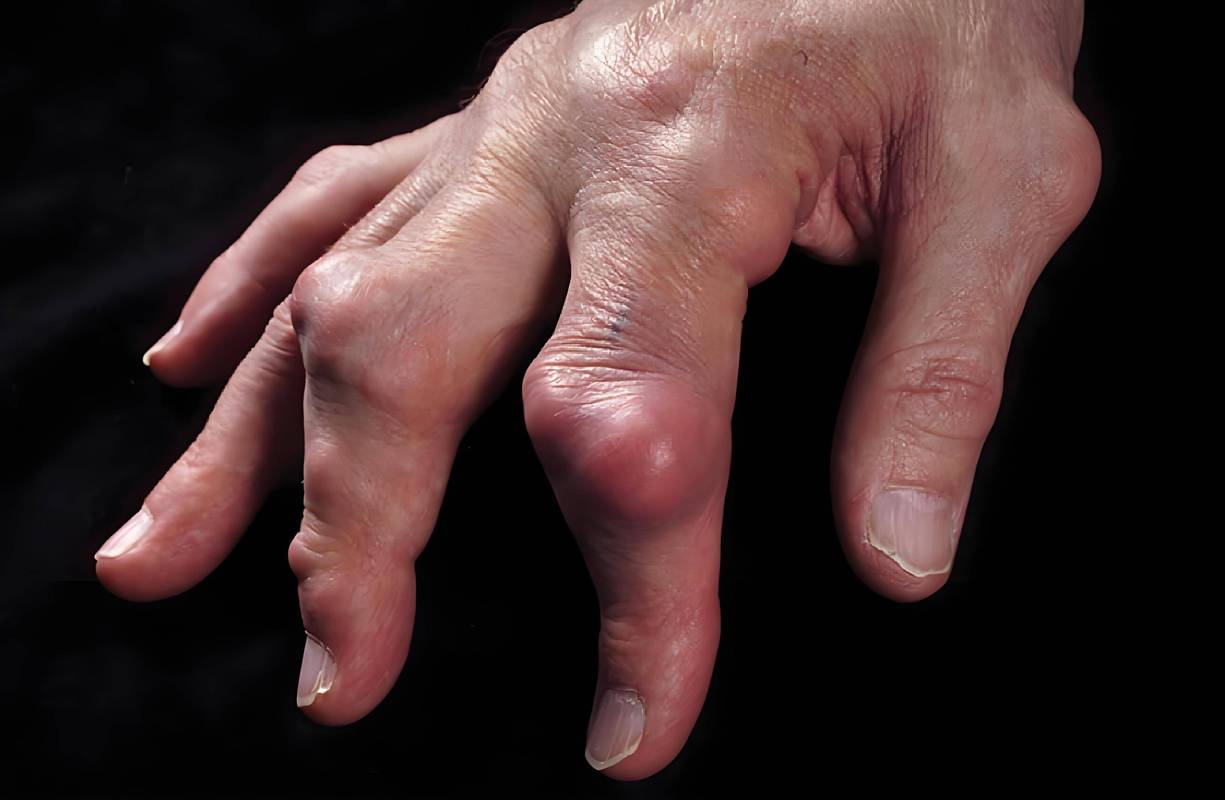 痛风后遗症有哪些症状