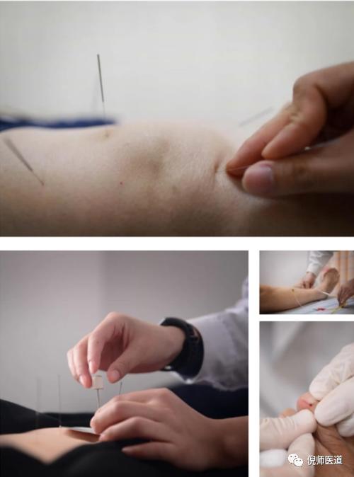 乳腺不通可以针灸吗