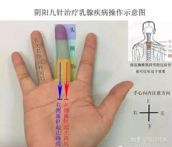 乳腺不通可以针灸吗