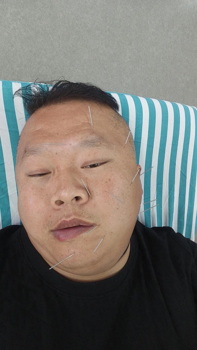 亨特氏面瘫针灸效果