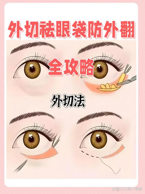 去眼袋手术真的安全吗