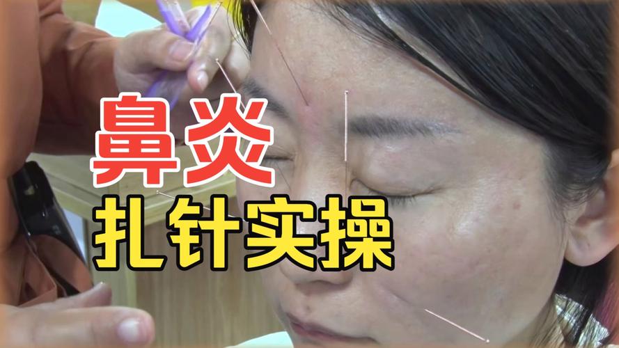 脸部过敏的针灸治疗