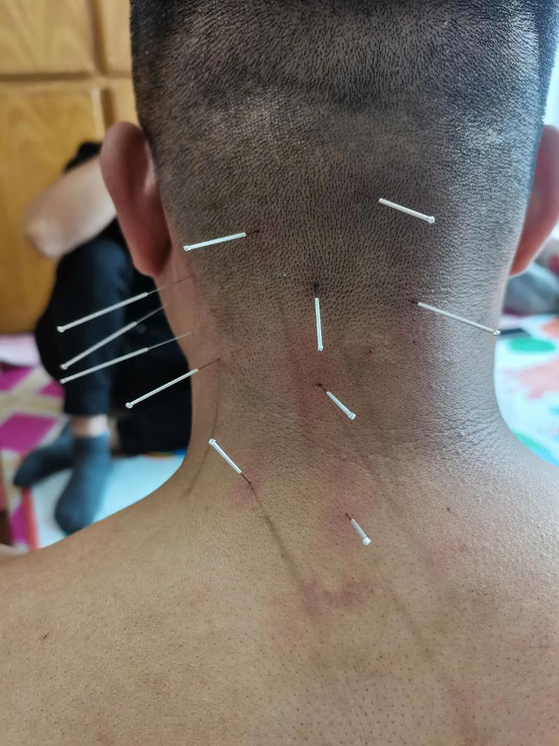 颈椎突出针灸管用吗