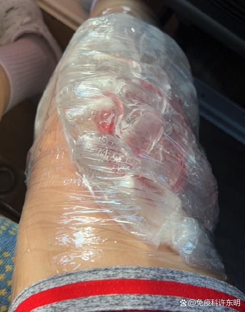 痛风会引起膝盖积液吗