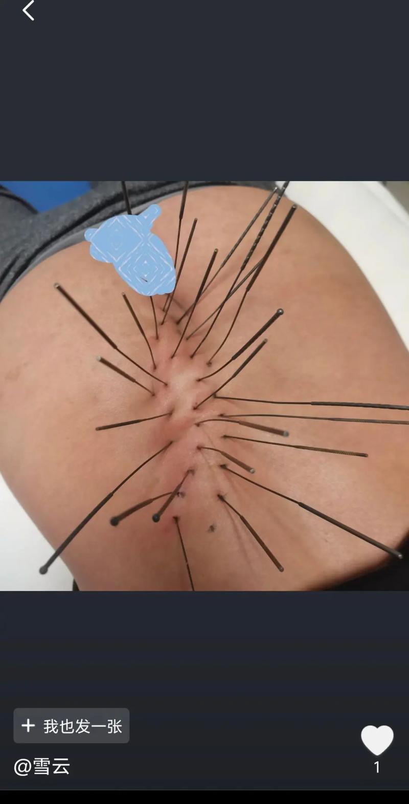 腰肌劳损针灸有用么