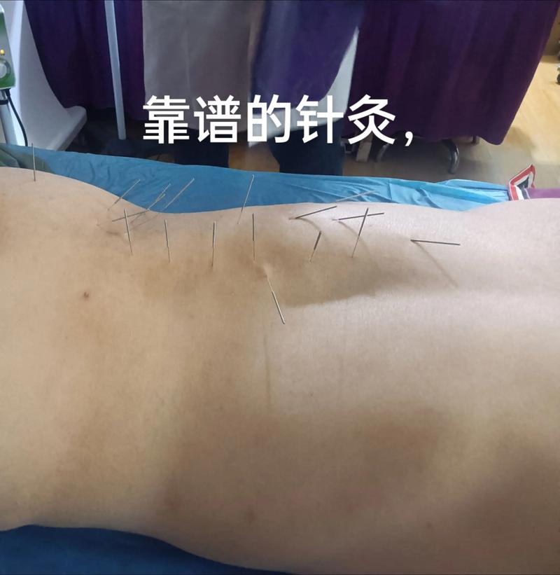 宫颈息肉可以针灸吗