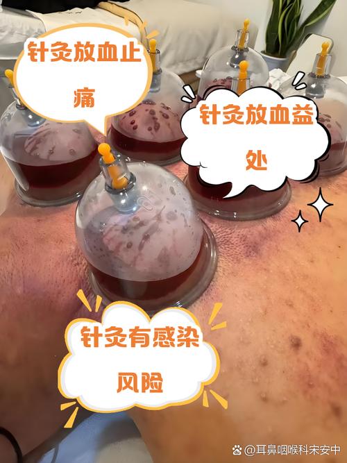 针灸放血疗法的作用