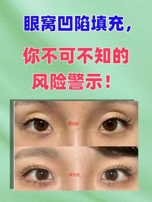 玻尿酸填充眼窝安全吗